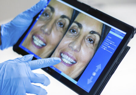 Cómo se pone una carilla dental