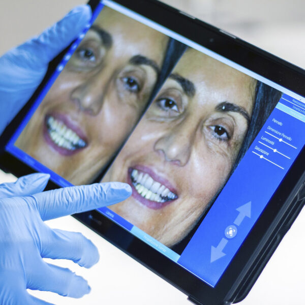 todo sobre como se pone una carilla dental