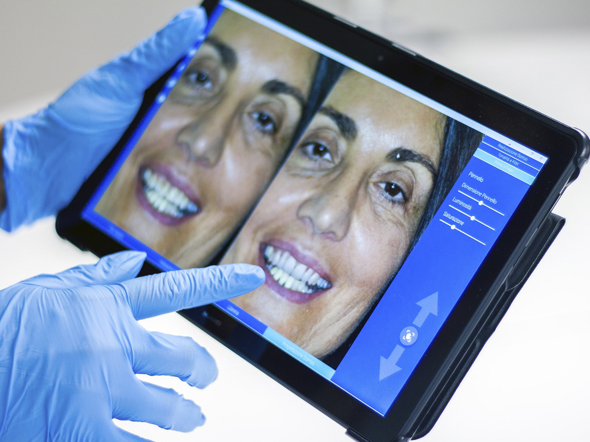 todo sobre como se pone una carilla dental
