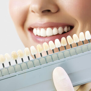 Blanqueamiento Dental