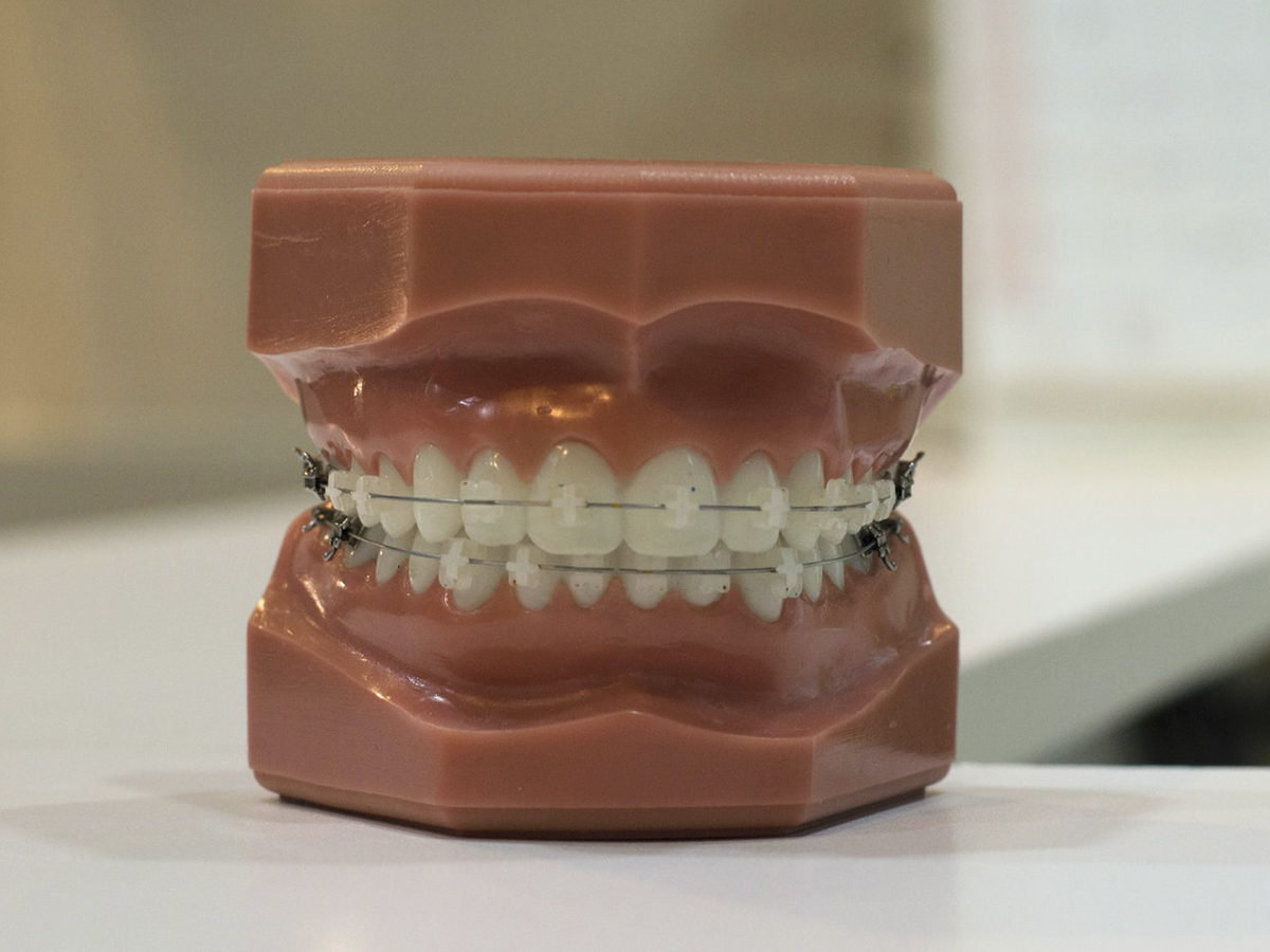 Qué hacer si te duelen los brackets