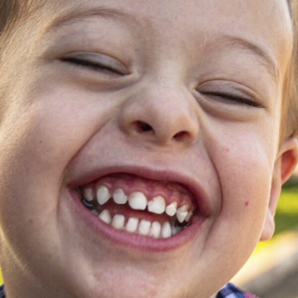 Descubre mucho más sobre el alargamiento coronario