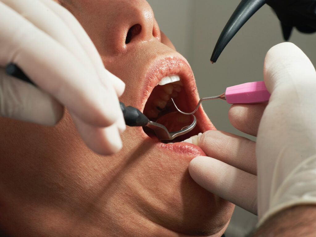 Duele un empaste dental.