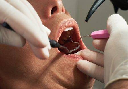 ¿Duele un empaste dental?