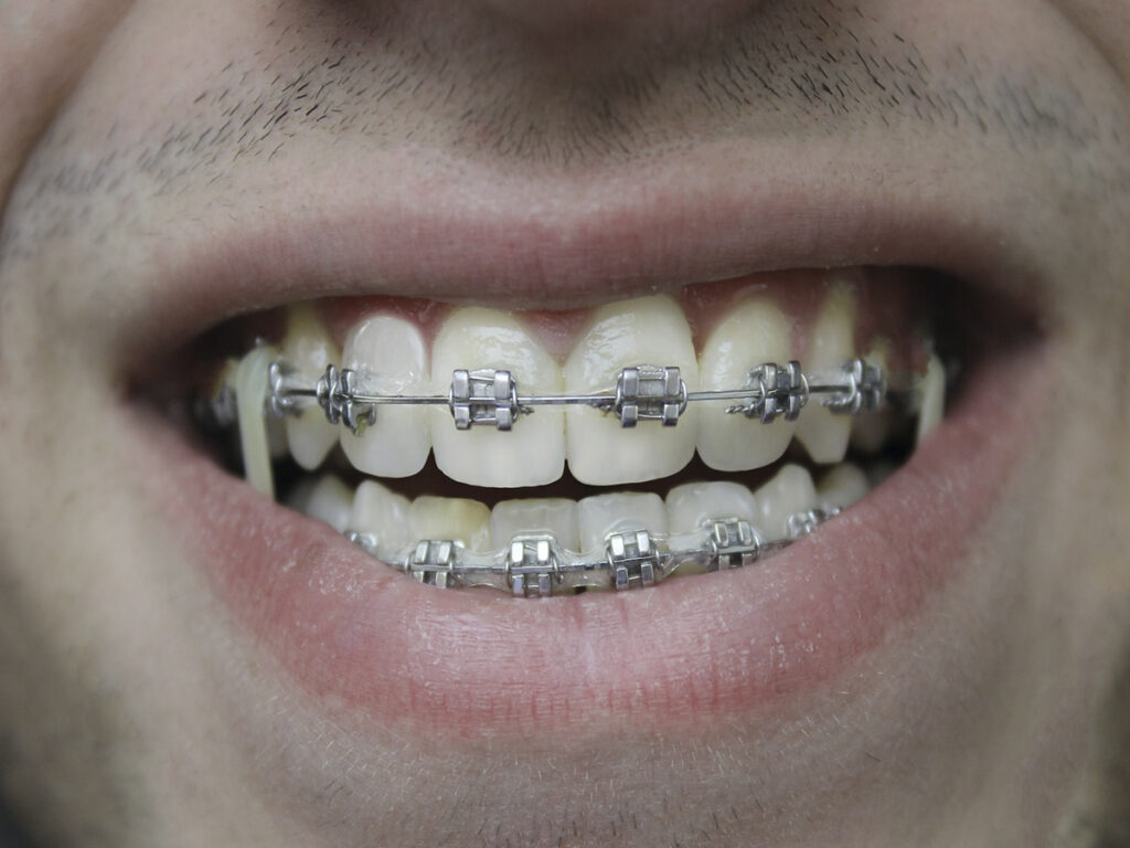 Descubre mucho más sobre los microimplantes