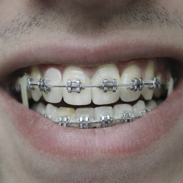 Descubre mucho más sobre los microimplantes