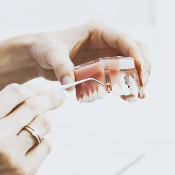 la importancia de como limpiar implantes dentales fijos