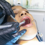 absceso periapical