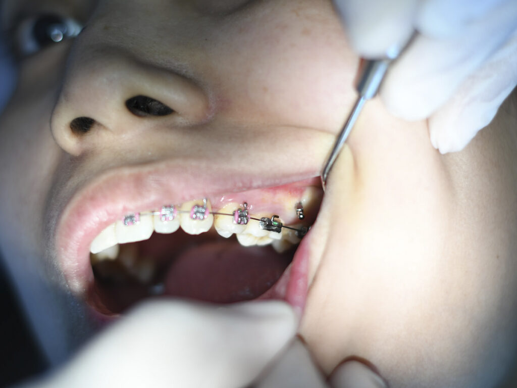 ajuste de brackets