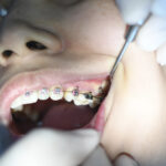 ajuste de brackets
