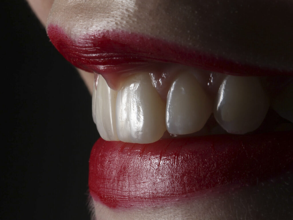 qué es la resina dental en odontología